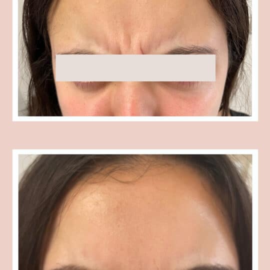Treatment- Xeomin 20 units to forehead lines