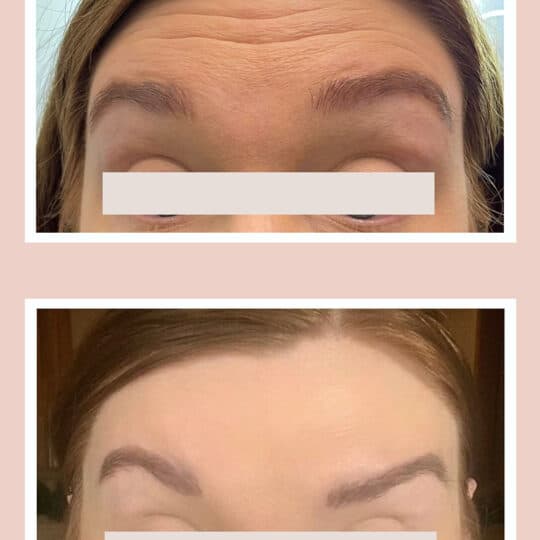 Treatment- Xeomin 16 units to forehead lines