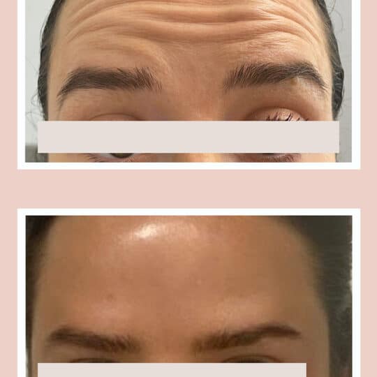Treatment- Xeomin 20 units to frown lines and 4 units bunny lines